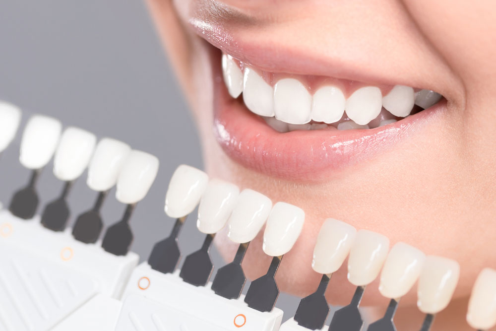 Estética dental en Villarrobledo