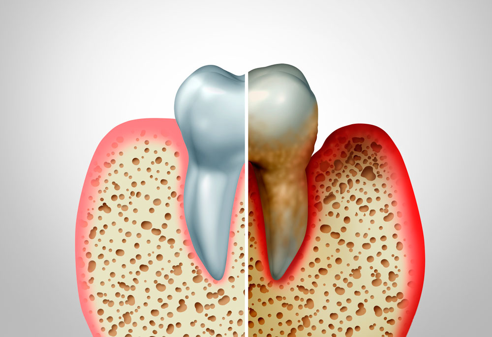 Periodoncia en Villarrobledo