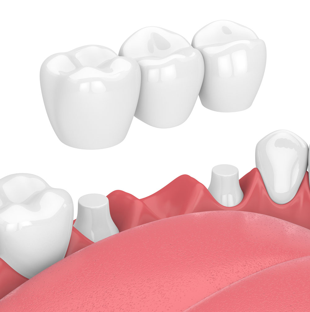 Prótesis dentales en Villarrobledo