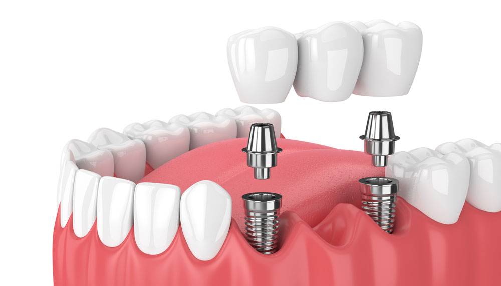 Prótesis dentales en Villarrobledo