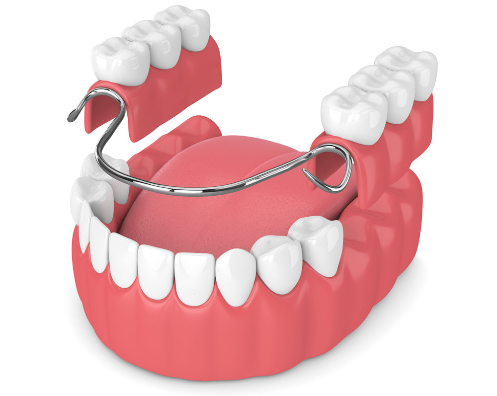 Prótesis dentales en Villarrobledo
