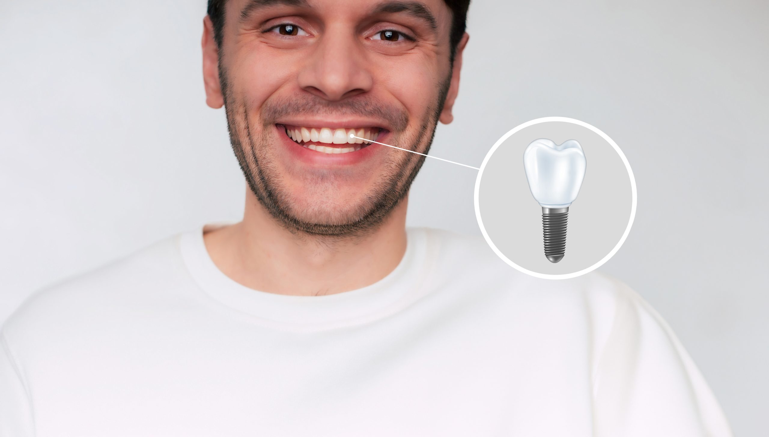 Implantes dentales en Villarrobledo