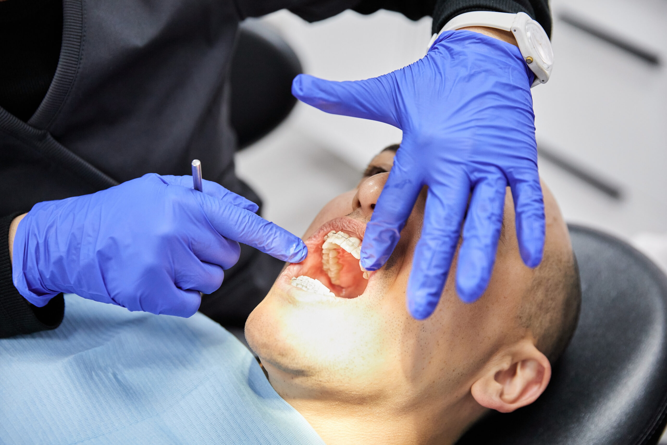 Efectos de la xerostomía en la salud bucodental