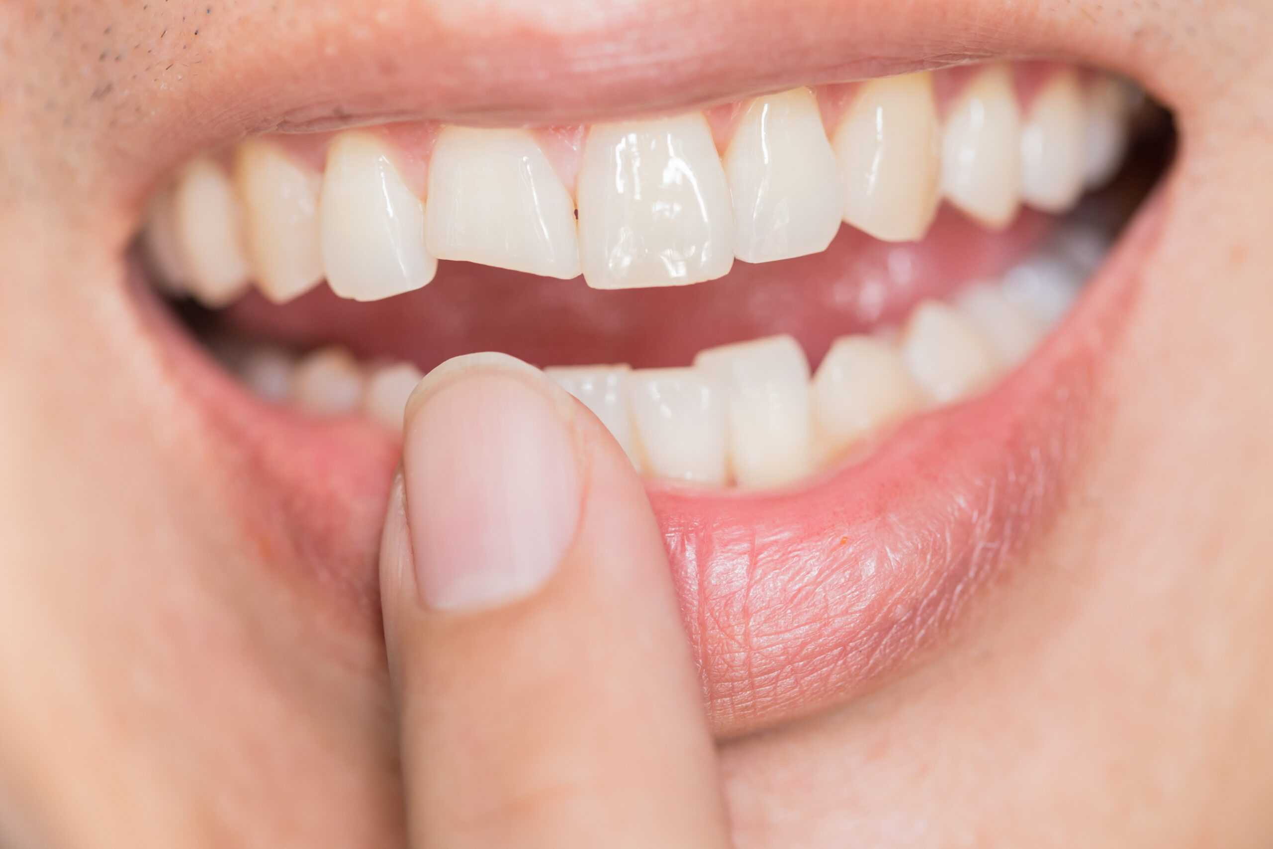 Traumatismos dentales